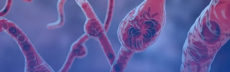 Varicose Veins
