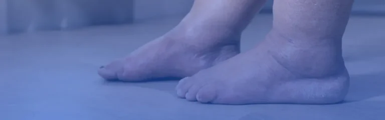 Leg Swelling