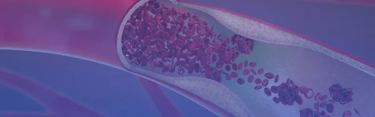 Peripheral Artery Disease